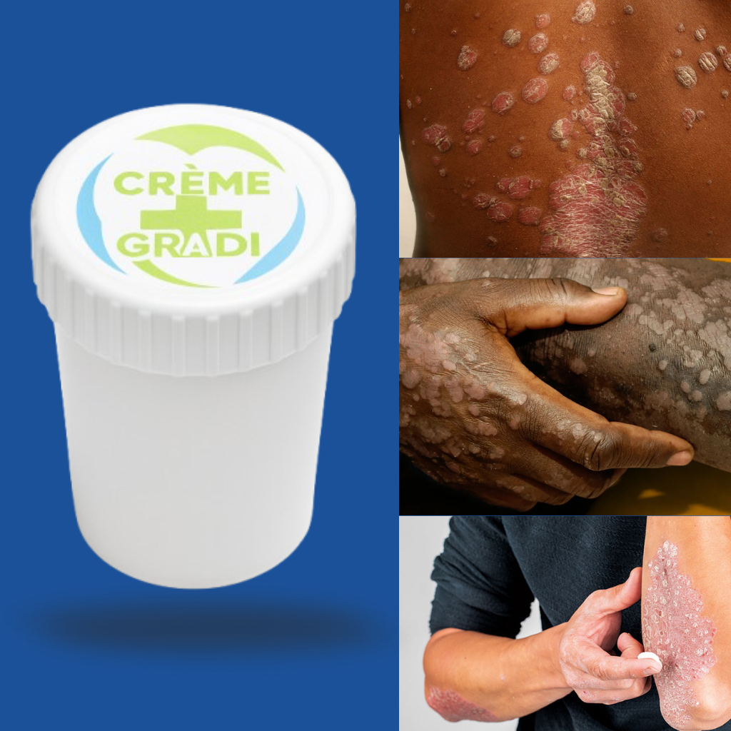 Crème Anti-Teigne™