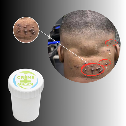 Anti-Boutons Chéloïde Derrière La Tête™